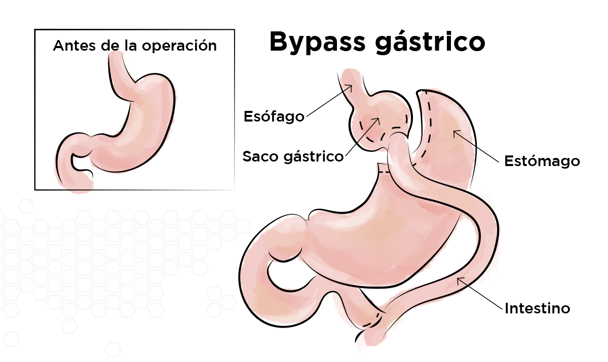 Bypass gstrico